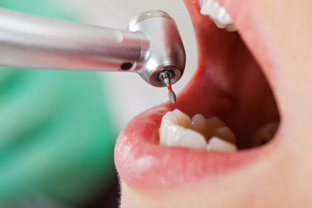 Best Emergency Dental Care for Broken or Chipped Teeth in Cloverly, MD